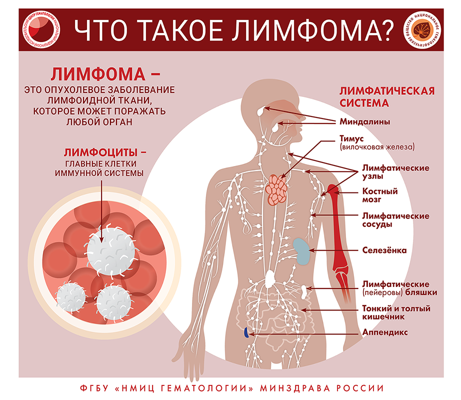 Что такое лимфома