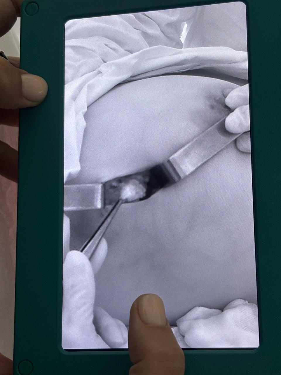 Современные методы лечения рака молочной железы